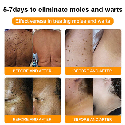 ATTDX Bee Venom Mole and Wart Treatment Cream